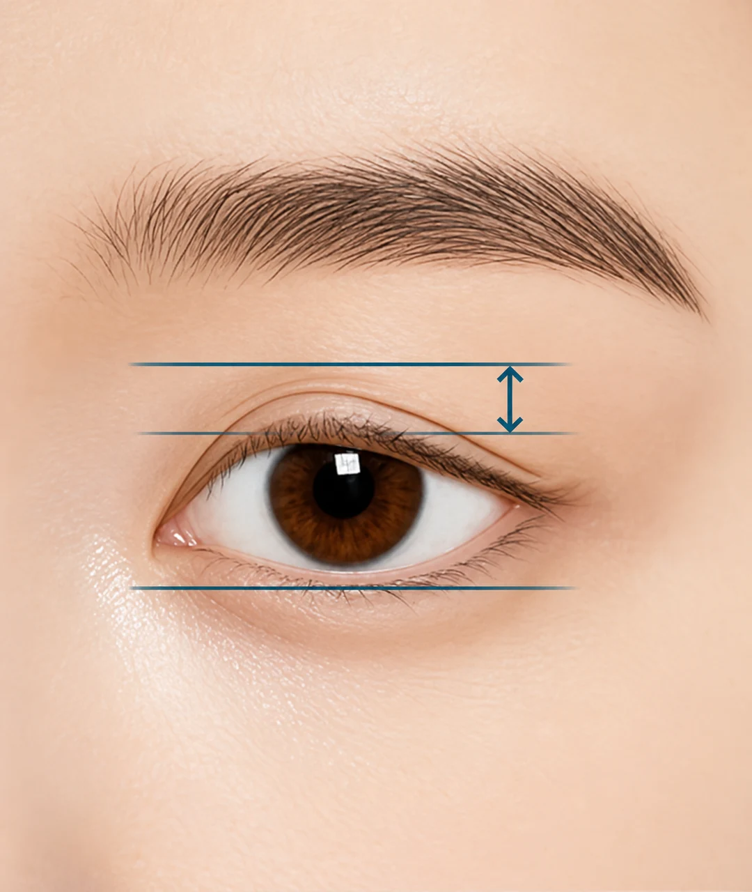 Upper eyelid skin