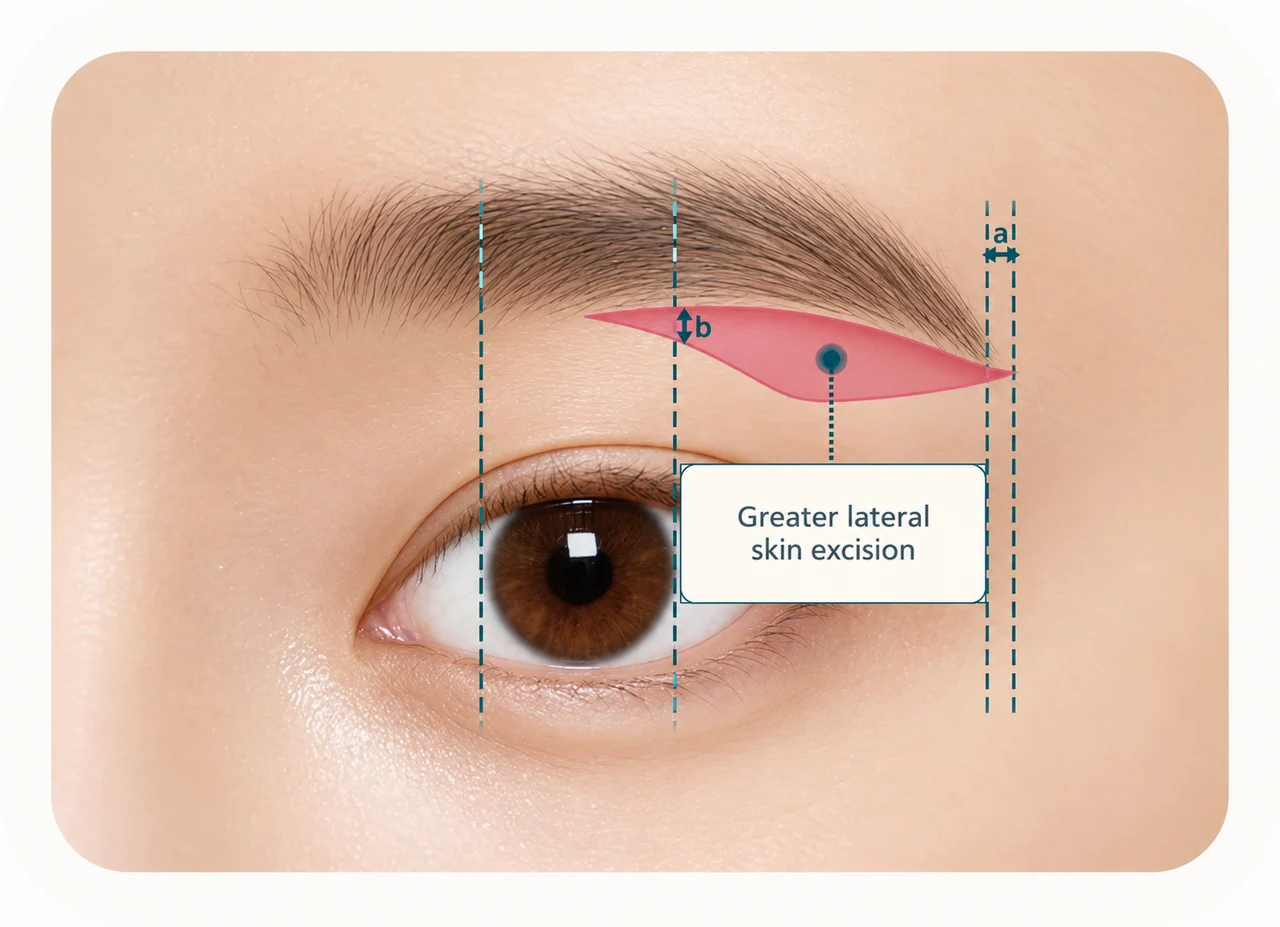 Sub-brow lift planning