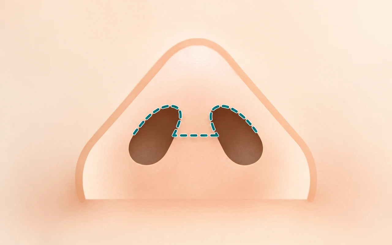 Internal incision approach
