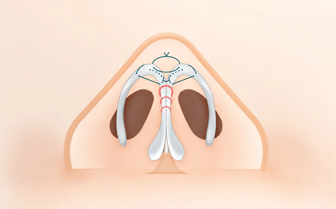 Tip cartilage positioning