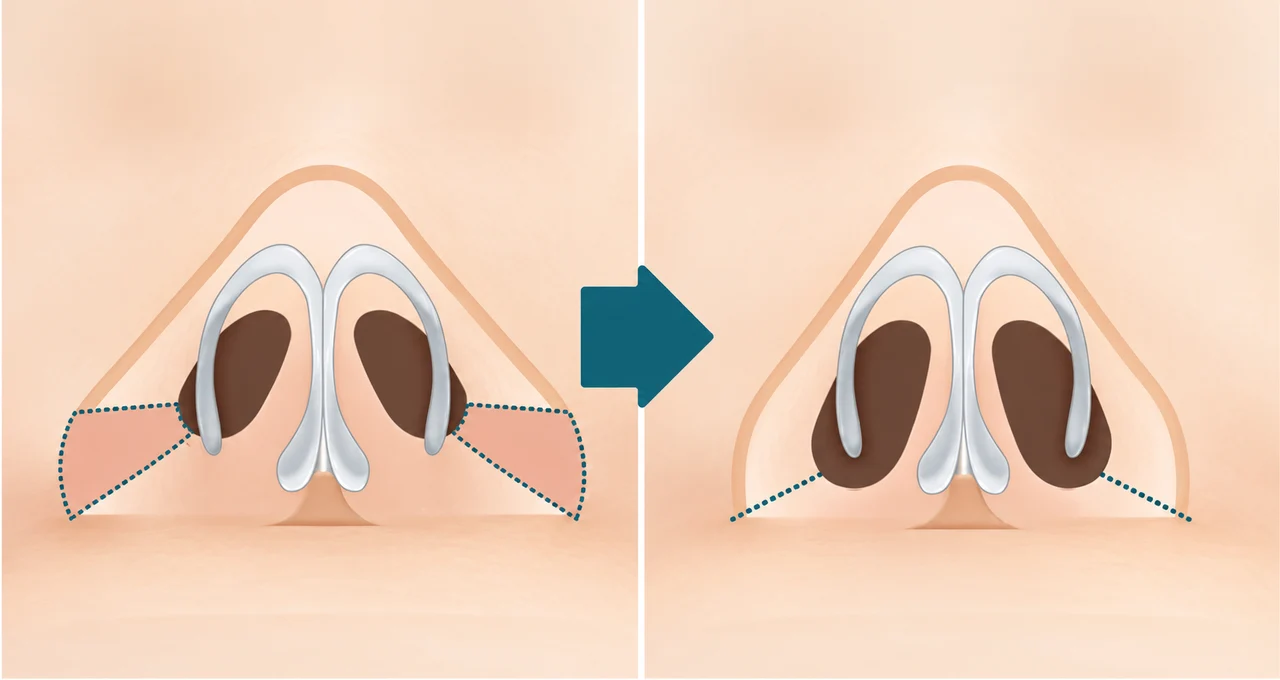 Nostril contour adjustment