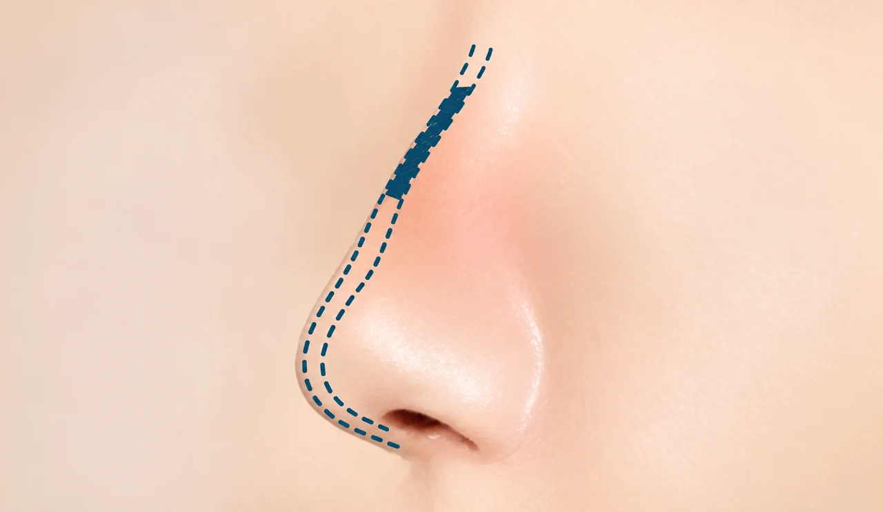 Implant contour planning