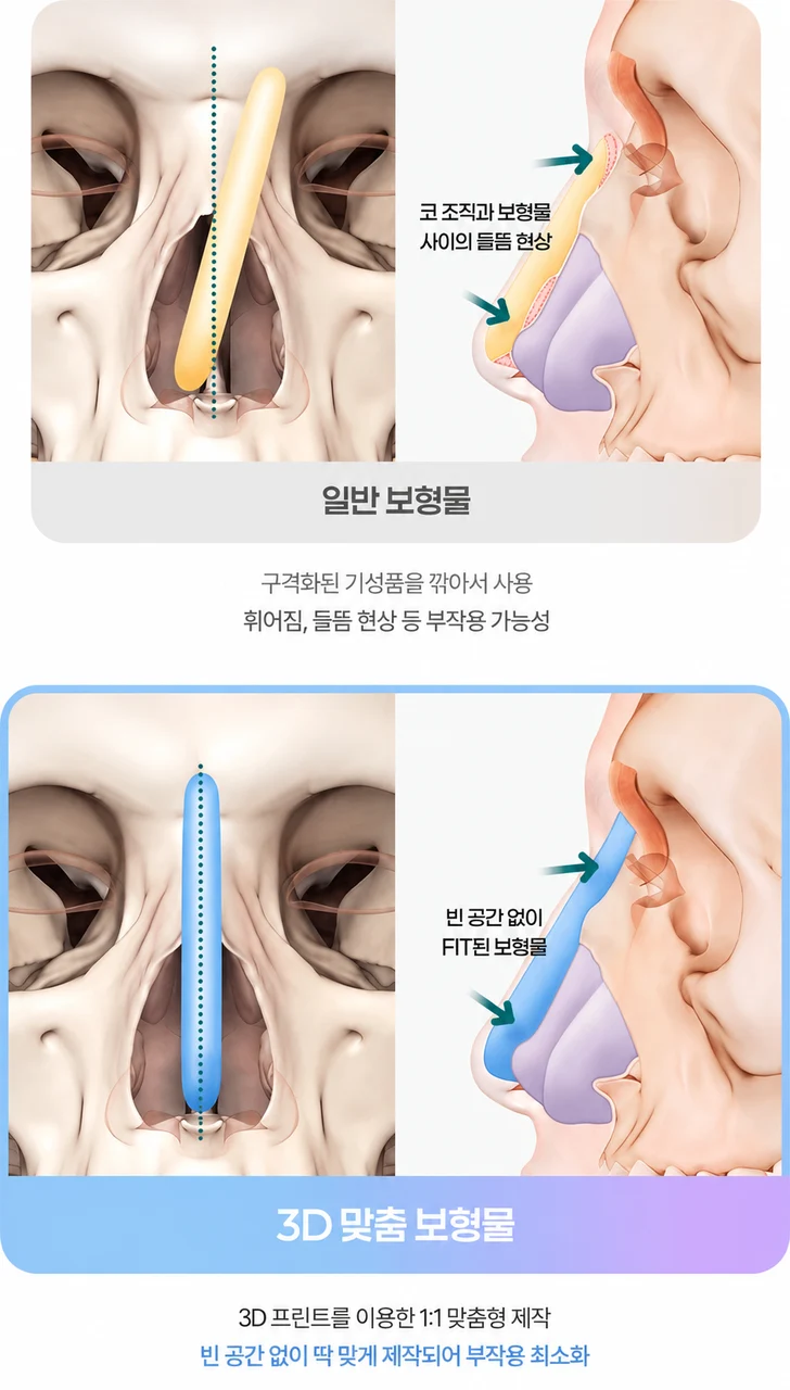 Custom implant design