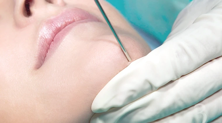 Precision contouring technique