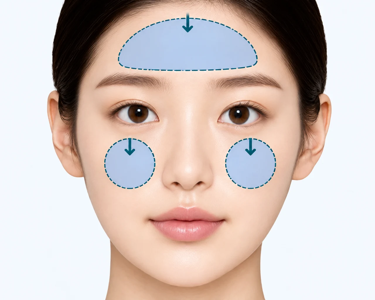 얼굴이 납작해 입체감이 부족한 경우 — 이마·앞볼 볼륨 부족으로 평면적으로 보이는 경우