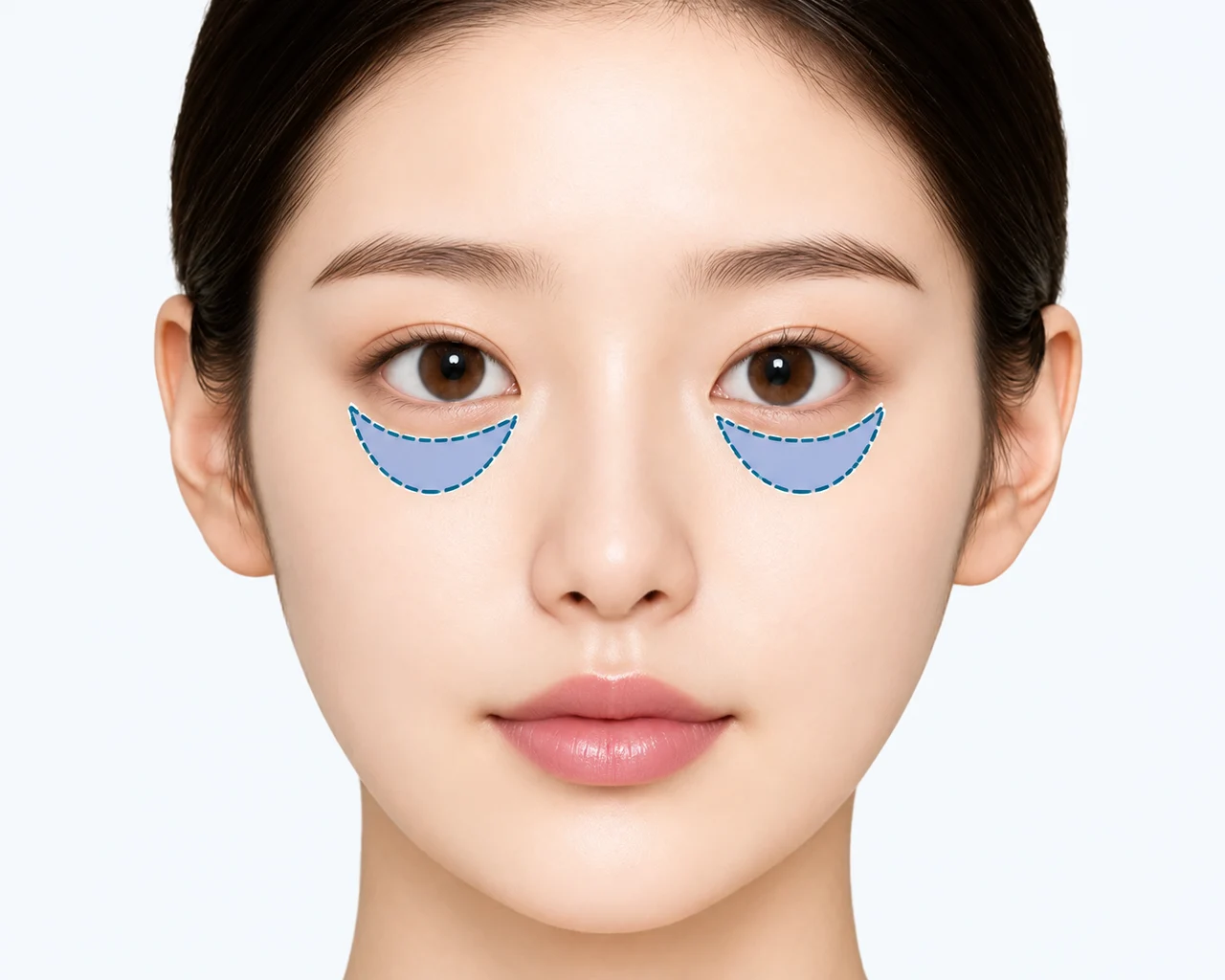 눈밑 꺼짐(눈물고랑)으로 어두워 보이는 경우 — 눈밑 지방 감소로 그늘이 생겨 다크서클처럼 보이는 경우