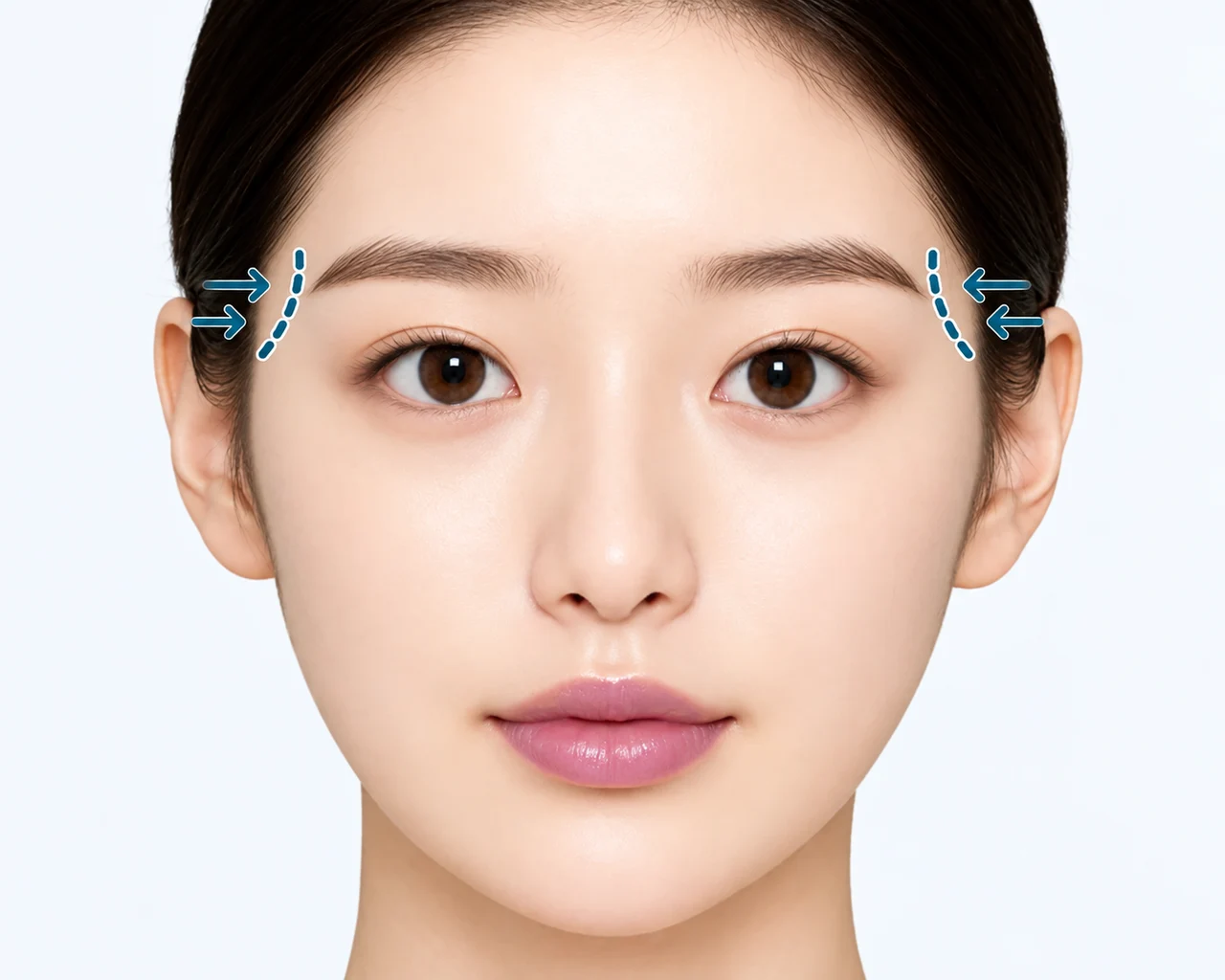관자놀이 꺼짐으로 얼굴 균형이 무너진 경우 — 관자놀이가 꺼져 광대가 더 커 보이는 경우