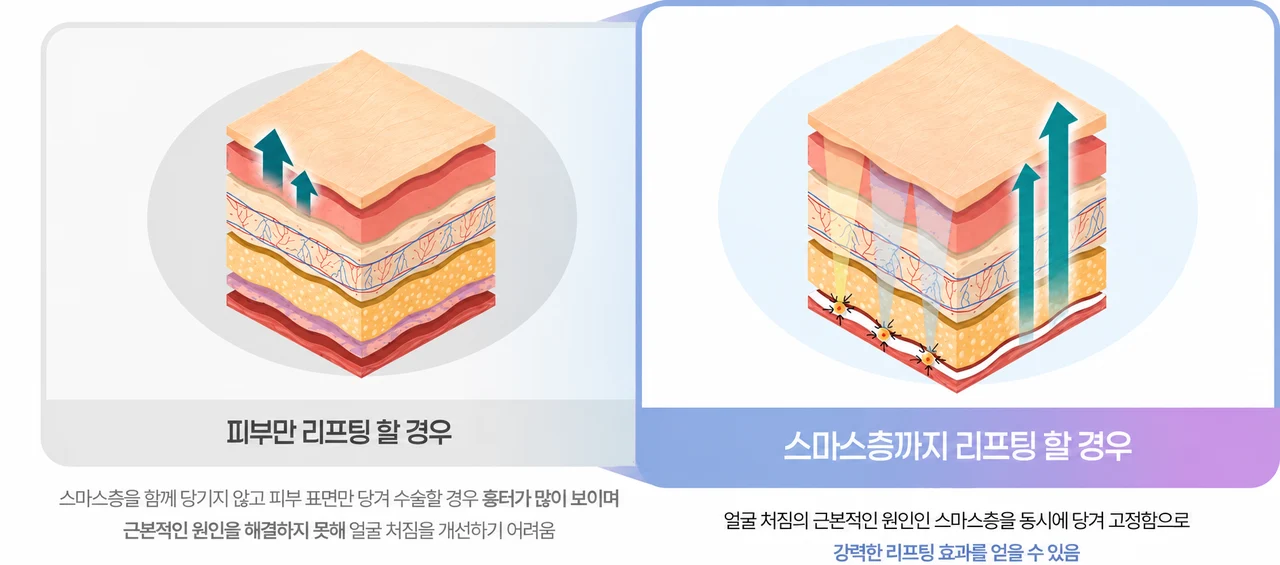 Skin and SMAS layers