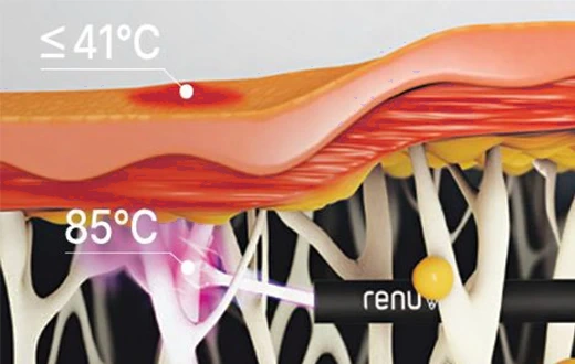 Tissue-layer treatment illustration