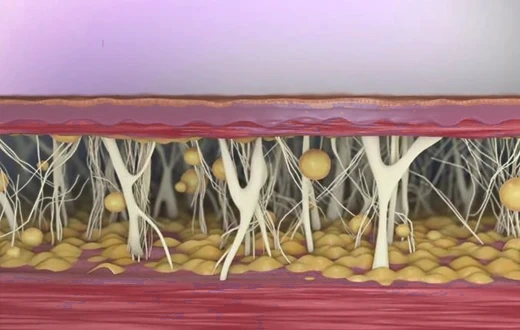 Subdermal treatment illustration