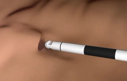Handpiece application