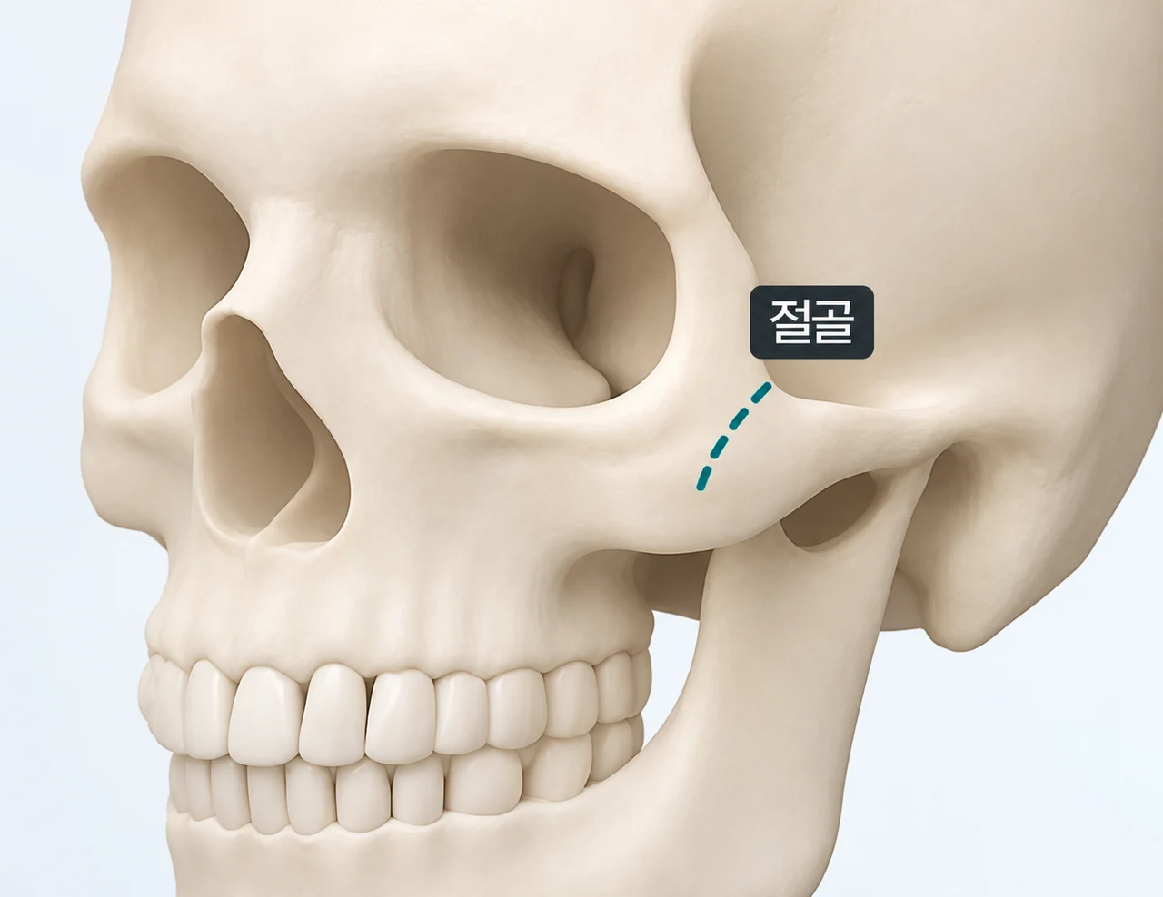 Lateral cheekbone anatomy