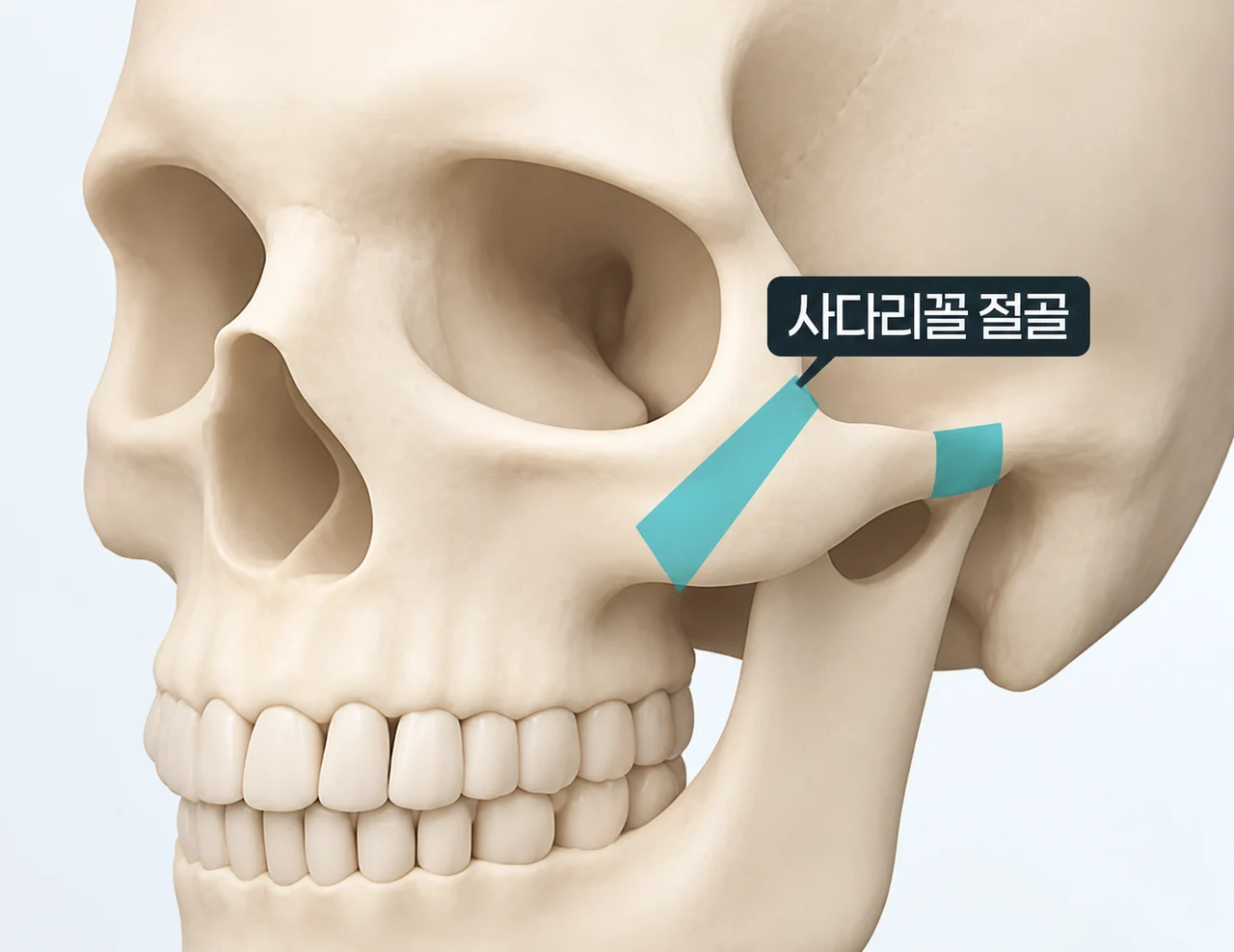 Oblique cheekbone anatomy