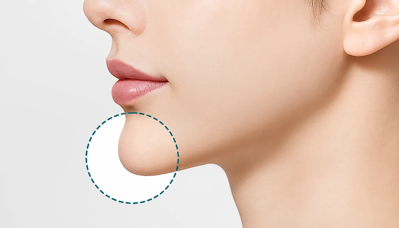 Chin projection assessment